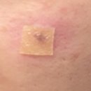 다홍한의원 | 천안 여드름 한의원 흉터 치료 새살침 / 패인 피부 관리 2회차 방문 후기