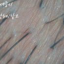 록진물산 | 세종시, 두피 속 진물나는 염증과 각질 관리 후기