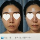 매그니유 | 리버스 갈바닉 고주파 마사지기 (하관 리프팅 솔직후기+ 사진첨부)