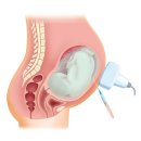 성복한의원 네이버블로그