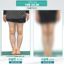뉴본의원 | 오다리수술 제주도에서 서울을 찾은분의 리얼 후기