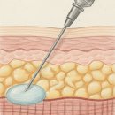 더힐즈의원 | 가슴필러 후기,잘못된 것은 피하고 안전을 위한 4가지 기준