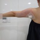 멍이 스타일 | 대전 팔뚝 무한람스 당일 시술 과정 솔직 후기 통증 멍 가격