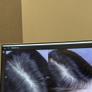 프렌닥터중앙의원 | 20대 여자 헤어라인 모발이식 7개월차 용닥터의원 후기 ①