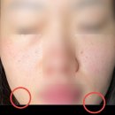 부산 결혼준비 | 제이린 남포 추천 레이저, 올인원 2회차, 점빼기 솔직후기