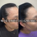 감쪽같이 | 거울 속 휑한 정수리, 인천 두피페인팅으로 감쪽같이 채운 후기 (비용, 정보 포함)