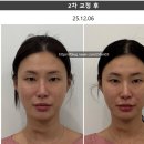 금침한의원 | 수원 리샘한의원 내돈내산 2회차 sp연예인(안면+두상)교정+ 팔자 볼륨 매선 + 미주안 + 연어PN 찐후기