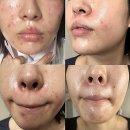 알파생기메디컬 | 여드름 홍조 혈관 레이저 부작용부터 통증까지 내돈내산 후기