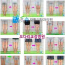 몸편한 제통 재활의학과의원 | 🦵 오다리 교정 후기 비수술 오다리 교정, 실패 없는 결과를 위해 꼭 알아야 할 모든 것