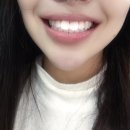 광주오치탑치과:) 내 돈으로 작성하는 찐 후기 치아미백 광주치아미백추천/북구미백치과/오치동치과추천...