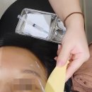 얼굴 | 강남역 피부과 땅콩형얼굴 쥬베룩볼륨 후기