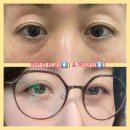 [하안검수술후기] 눈밑지가 아니라 하안검이라니