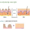 닥터포유 미세실 리프팅 이란? V라인과 리프팅효과가 뭉쳐!! 새로운 탄력 리프팅 시술입니다. 이미지