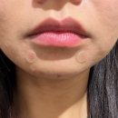 원케어메디칼 | 오산에스테틱 라보떼메디컬스킨케어 여드름 진정재생관리