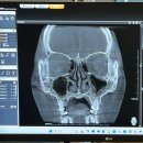연세고른숨이비인후과의원 | 기능코 성형 비염 수술 당일-4일차 후기(연세고른숨이비인후과/비중격만곡증)