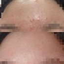스킨케어OiC | [스킨케어추천]여드름피부 3년 쓴 스킨케어 솔직후기 oic이뮤겔
