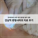 핀셋 | 강남역 편평사마귀 치료 후기, 핀셋 제거 받아본 솔직 경험