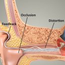 청담보청기 이미지