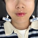 메트로메디칼 | [구래역] 구래동피부관리 초이스뷰티, 콜드플라스마 &amp; 물방울 탄력관리로 웨딩촬영 전 관리 리뷰