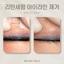 세븐일레븐 광주첨단라인점 | 리턴세럼 아이라인 문신 반영구 화장 안전하게 잔흔 제거 효과 후기 / 광주 수완지구 첨단