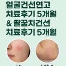 한민국제화학(주) | 얼굴건선연고 치료후기 5개월 팔꿈치건선 치료후기 5개월