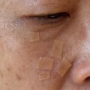 대박집경대점 | 대구피부관리 <페이즈스킨> 비립종 요철관리 대박집