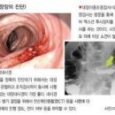 대장 용종 선종 & 톱니모양 용종 반드시 제거하고 대장암 예방하자 이미지