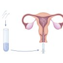 수정수지 이미지