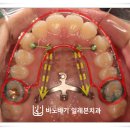 보아리오 치과기공소 | 덧니교정비용 및 교정후기 “이것”부터 참고해야