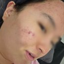 폴리프라자 | 양주 옥정동 피부관리 로덱스스킨앤왁싱 여드름 관리 솔직후기