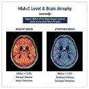 건강태극권(실용) | 뇌위축과 당화혈색소의 관계