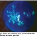 단순포진 바이러스 (herpes simplex virus, HSV)와 전층 각막이식술 (PKP, corneal transplantation)