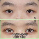 눈매교정으로 졸려보이는 인상 개선!매력적인 눈 만들기