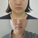 서울)고주파+캐비테이션,오토젯 두대구매시 아이셀 기기도 함께 드려요 이미지