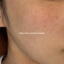 서울락비뇨기과의원 | 선릉 힐 비뇨기과 잡티 제거 예약 성공 자세한 후기