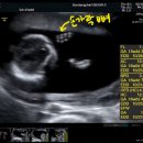 양수약국 | [13-17주]모자이시즘배아 양수검사 후기+비용