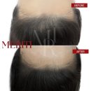 연헤어라인 네이버블로그