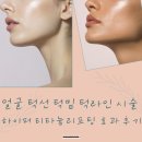 오메가전기·조명 | 청담피부과 하이퍼 티타늄리프팅 효과 후기 턱선 턱밑 턱라인 시술