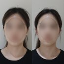 [서초/강남 윤곽관리샵] 강남역 리프팅, 얼굴이 작아지는!! 오직얼굴연구소 서초점