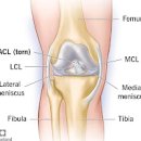 십자인대파열 원인 증상 치료 십자인대파열 재활운동 전방 후방 십자인대 이미지