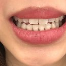 여의도 치과 치아미백 내돈내산 솔직후기 | 화이트닝 시술 가격·통증·변화