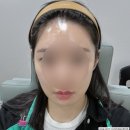 하나의원 앞 | 얀의원 쥬베룩 볼륨 , 팔자 옆볼 2회차 후기