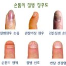 손톱으로 예견해 보는 건강 - 손톱에 건강정보가 있다. 이미지