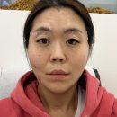 실디자인 | 처진얼굴리프팅 + 실리프팅후기 가격 비용 실리프팅잘하는곳 솔직 후기 (통증)