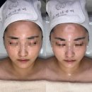 광주 피부관리 글리나뷰티 솔직후기