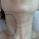 시내온누리약국 | 강릉 마운자로 부작용 및 통증 후기