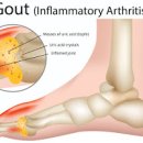 통풍 원인 초기 증상 치료 통풍 안 좋은 음식 통풍 통증 요산 수치 이미지