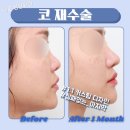 차이성형외과 | 코재수술 성형외과, 비용 & 후기 사진 확인하세요