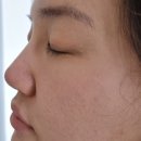 메디큐브의원 | 메디큐브의원 강남점 쁘띠장인 매부리코 코필러 후기 (전후사진, 붓기, 통증, 몰딩)