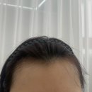 피씨엘코리아 | 강남 헤어라인 반영구 피씨엘코리아 두피SMP 후기 PCL Korea